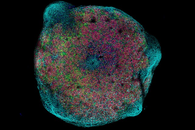 Minicervelli da cellule staminali riprogrammate per studiare le cause genetiche della microcefalia